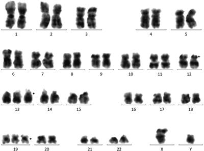 BCORL1 S878G, GNB1 G116S, SH2B3 A536T, and KMT2D S3708R tetramutation co-contribute to a pediatric acute myeloid leukemia: Case report and literature review